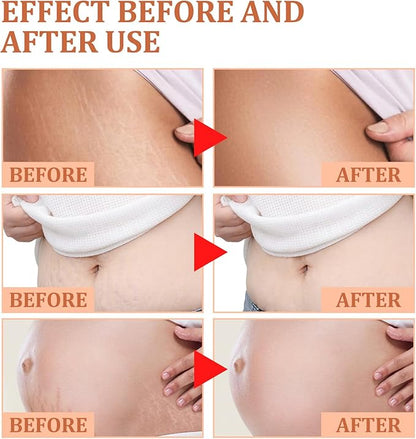 Eelhoe - Stretch Marks Removal Cream