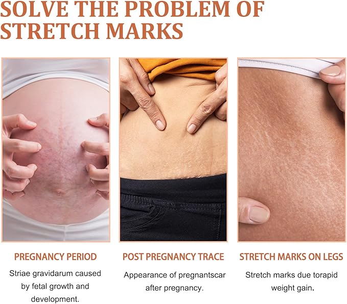 Eelhoe - Stretch Marks Removal Cream