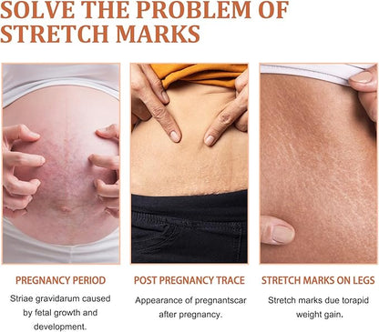 Eelhoe - Stretch Marks Removal Cream