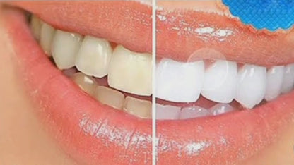Tooth Whitening System